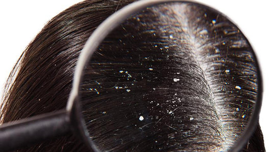 dandruff on scalp